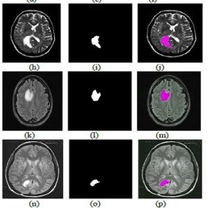 تشخیص تومور در تصاویر MRI