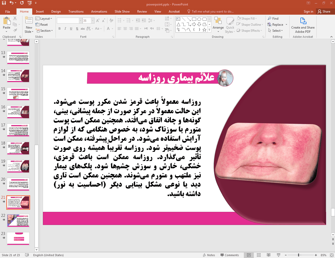 علائم بیماری روزانسه