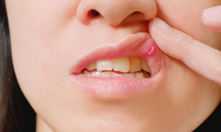 اختلالات لب، دهان و لثه