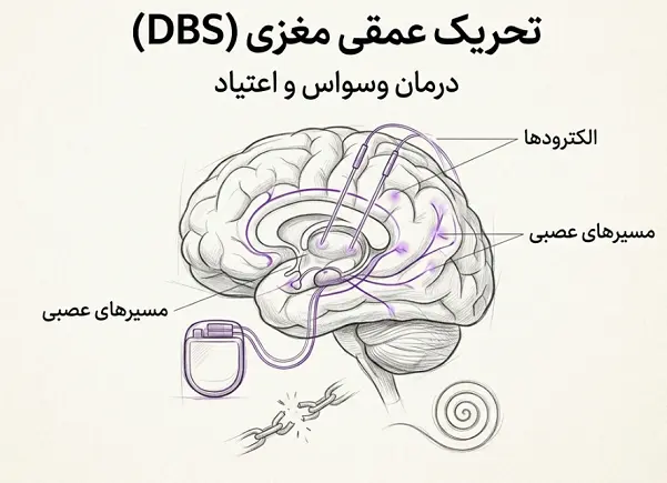 تحریک عمقی مغزی